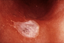 Поки не існує жодного свідоцтва того, що люди з виразкою шлунка насправді мають більше шансів на розвиток хвороби Паркінсона Поки не існує жодного свідоцтва того, що люди з виразкою шлунка насправді мають більше шансів на розвиток хвороби Паркінсона